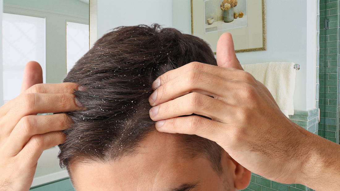 Flake-Free Scalp: My Dandruff Shampoo and Rosemary Oil Hack