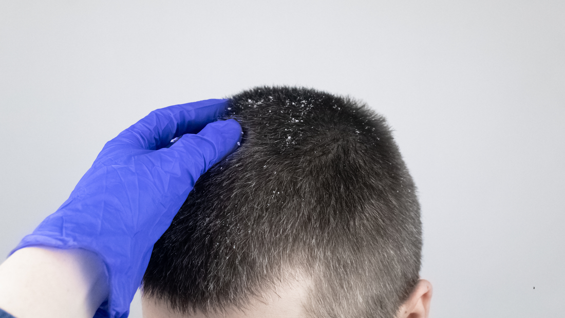 Lidiando con la Caspa y el Cuero Cabelludo Seco en Mi Barbería